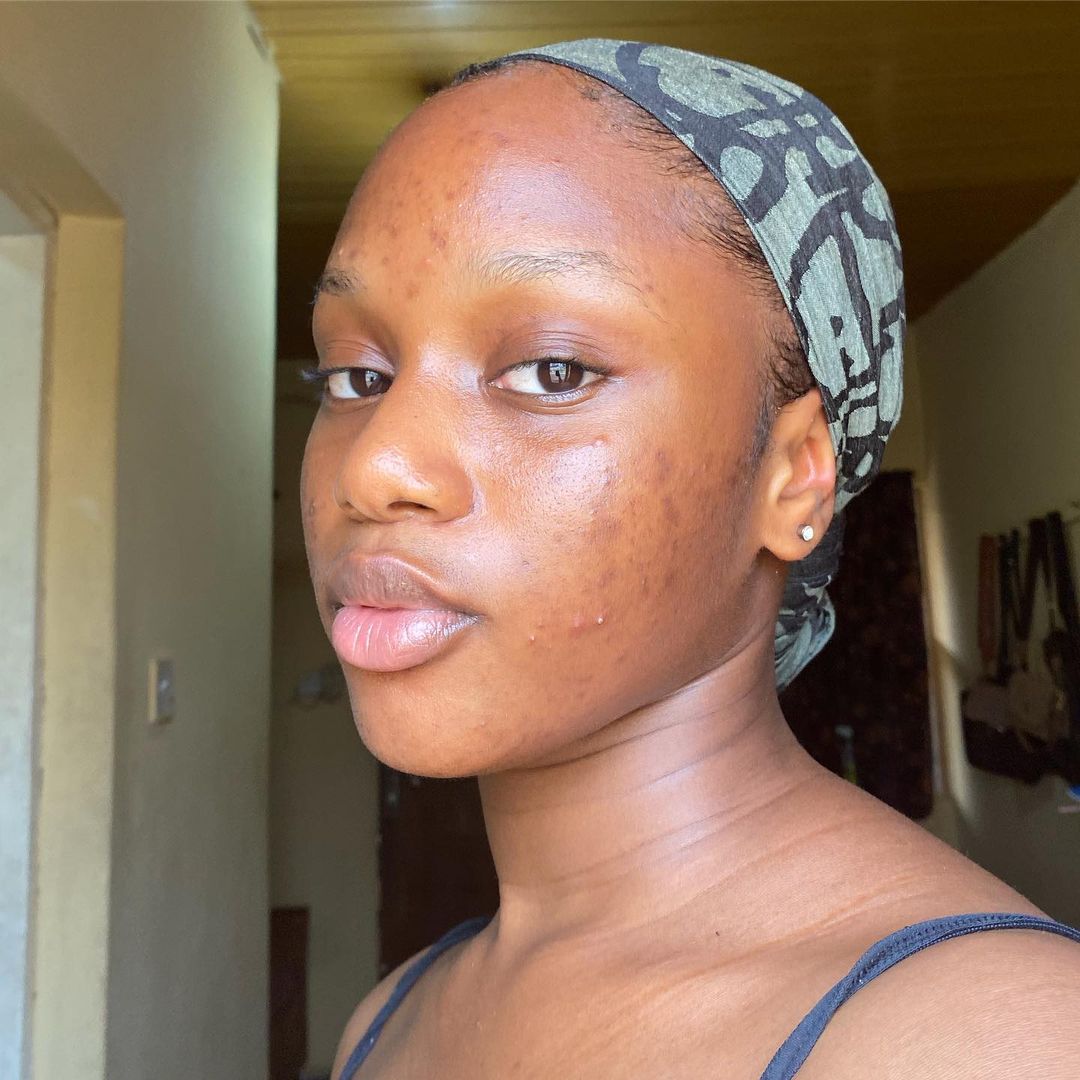 Brown-skinned girl with hyperpigmentation