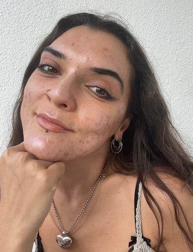Skinfluencer, @Cystur, On How KILLA Changed The Game For Her Deep Zits