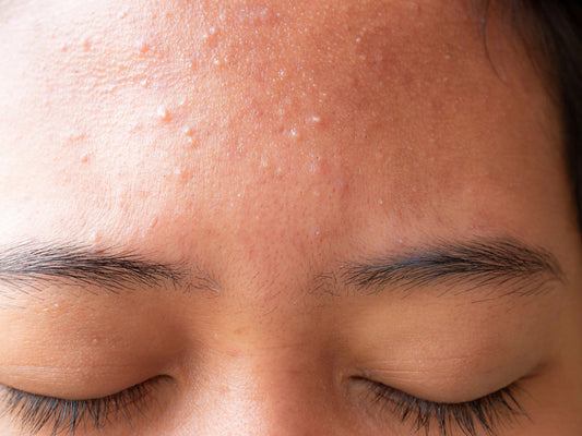 How to Get Rid of Small Bumps on Your Forehead