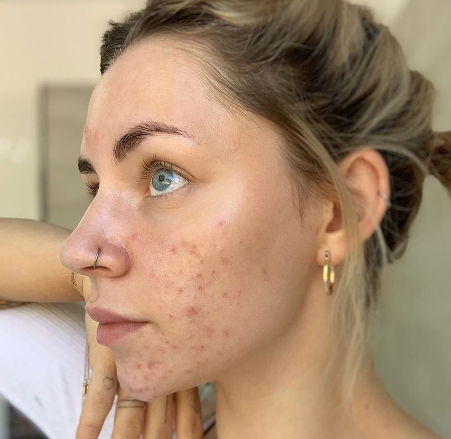 FaceTime: Skin Positivity Advocate, Emily Longdin