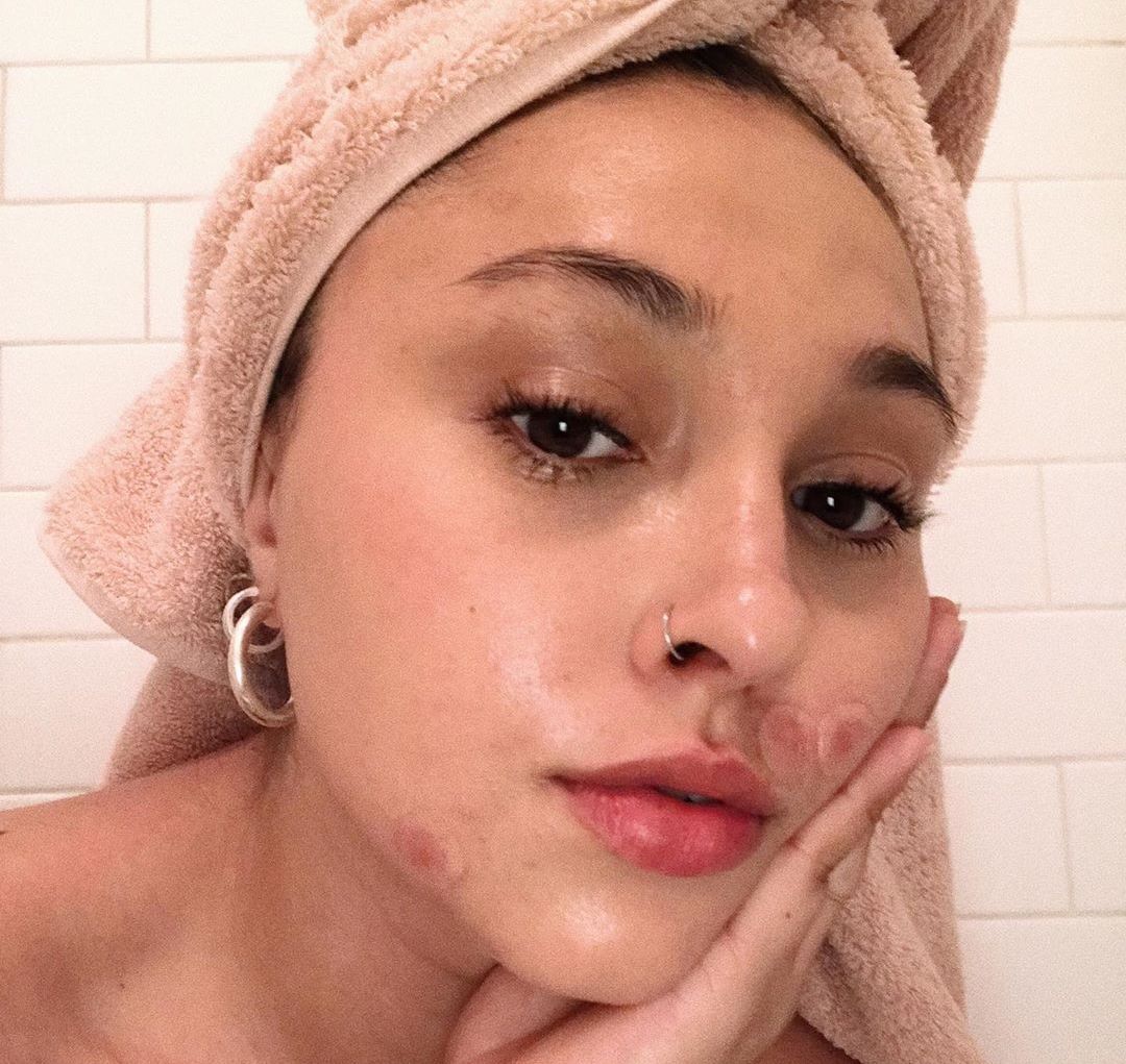 Model wears ZitSticka KILLA pimple patches