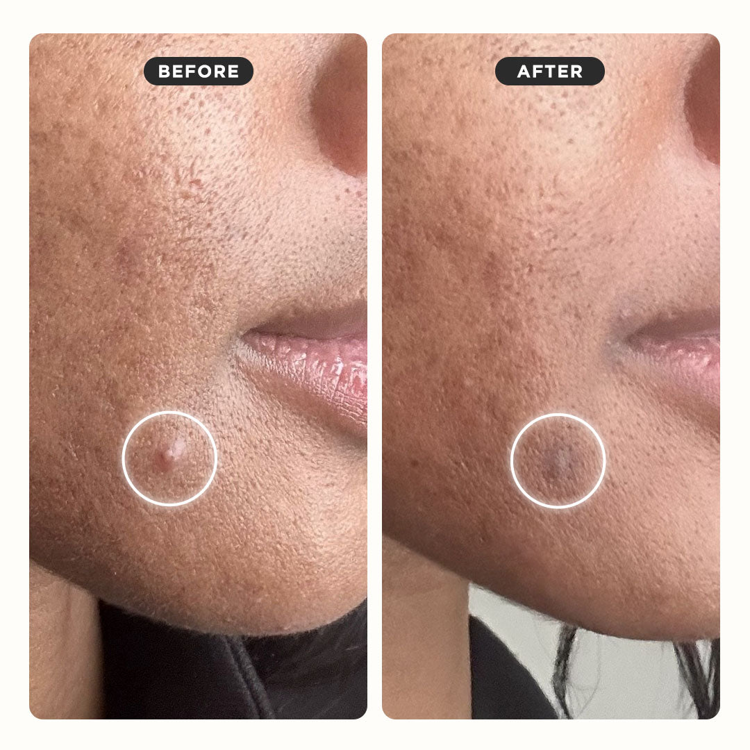 KILLA™ ACNE EXTRA STRENGTH - Monthly