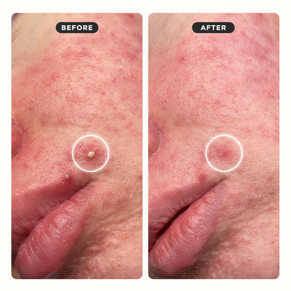 UNDERCOVER Blemish Patches Monthly